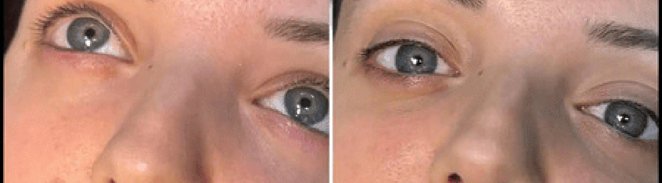 Dermal Fillers